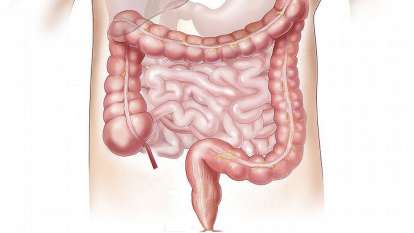 Intestino irritabile